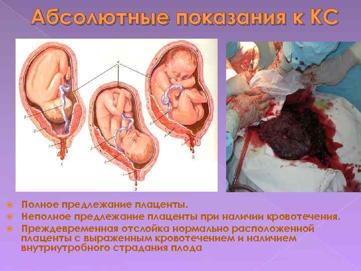 Низкая плацента при беременности: чем опасна и как рожать?