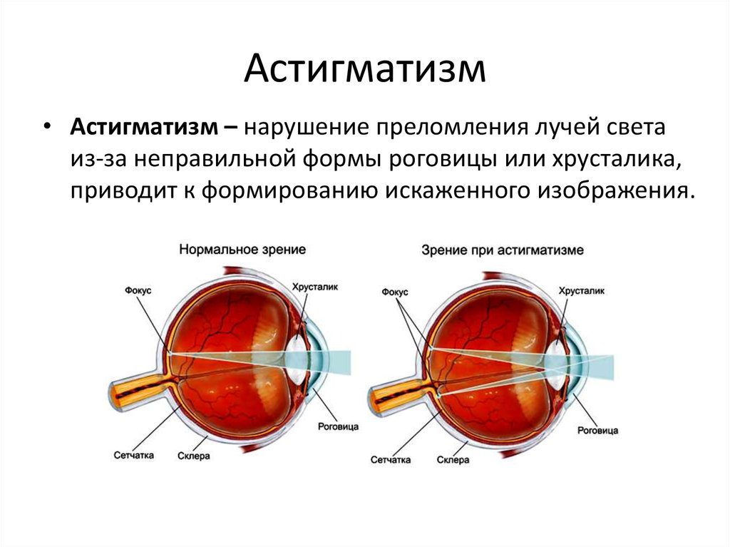 Как раньше лечили катаракту народными методами