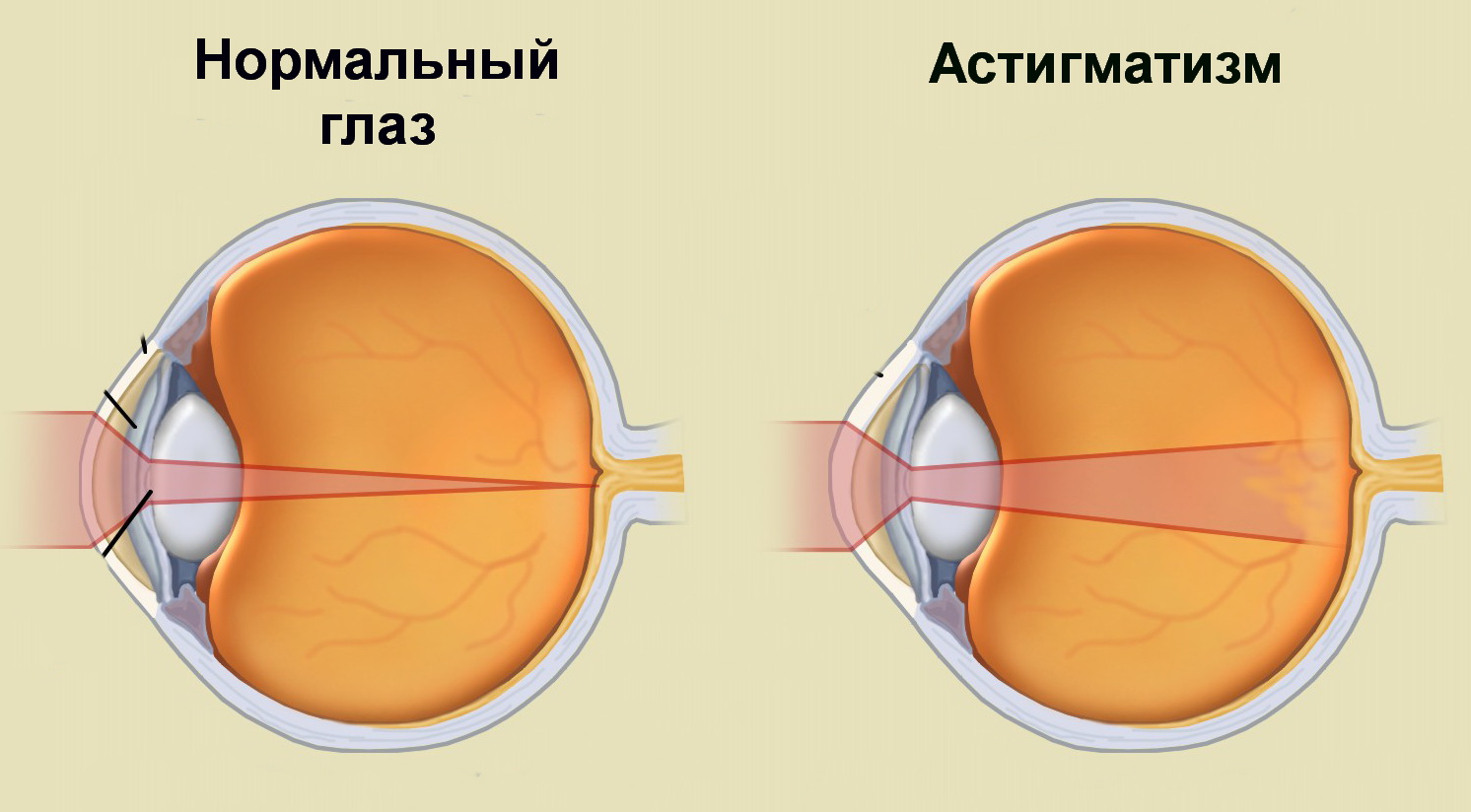 Лечится ли астигматизм или, как исправить астигматизм у взрослых?